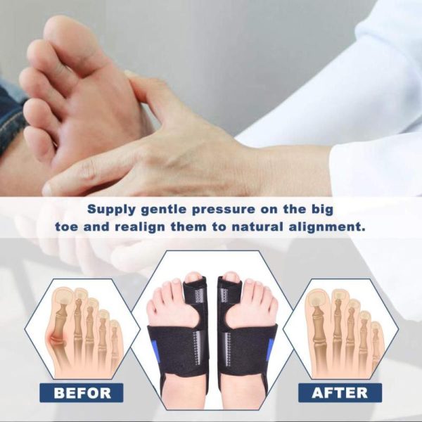 Medical Supplies |   Bunion Corrector Orthopedic Splint Big Toe Separator Pain Relief Non-Surgical Hallux Valgus Correcti Health Medical Supplies